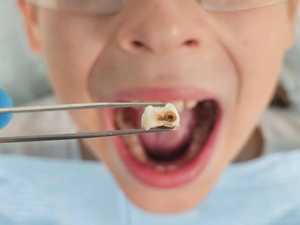 Best Emergency Dentist for Lost Fillings or Crowns in Stormstown, PA